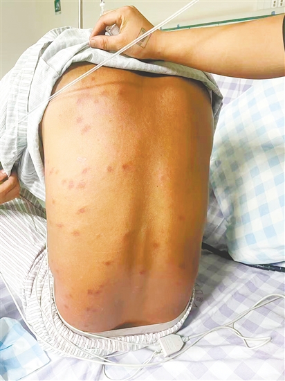 患者全身多處被馬蜂蜇傷。